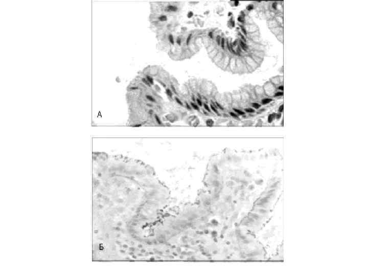В случае неэффективности трехкомпонентной терапии, 1 а А включающей ИПП и кларитромицин, показана четырехкомпонентная