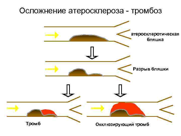 Осложнение атеросклероза - тромбоз атеросклеротическая бляшка Разрыв бляшки Тромб Окклюзирующий тромб 