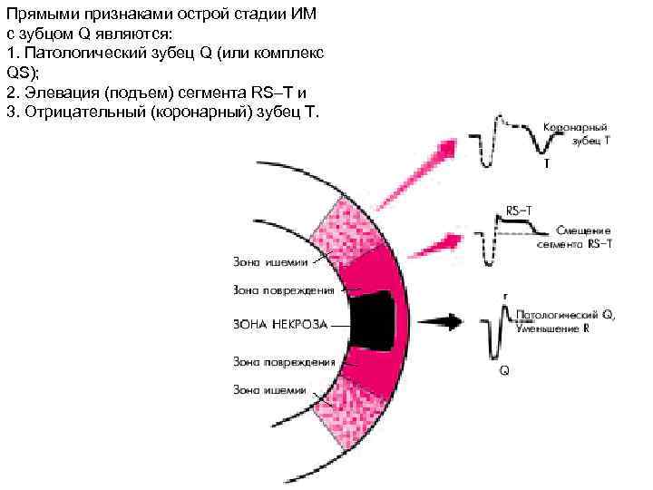 Прямыми признаками острой стадии ИМ с зубцом Q являются: 1. Патологический зубец Q (или