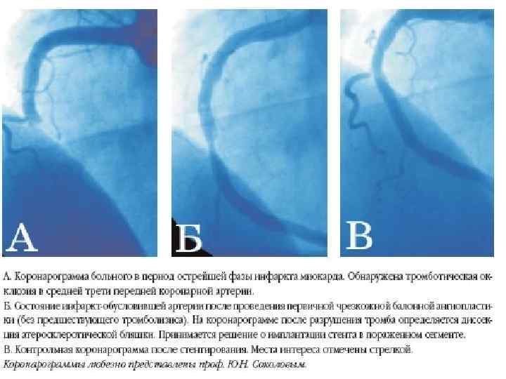 Что такое стент на сердце после инфаркта фото