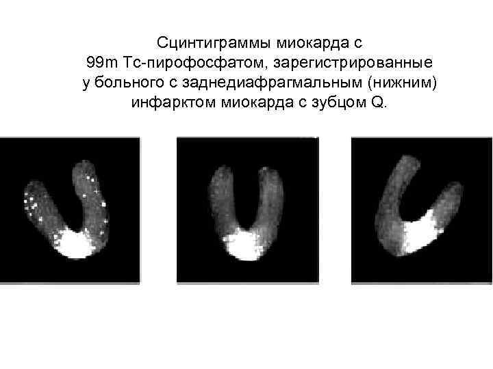 Сцинтиграммы миокарда с 99 m Тс-пирофосфатом, зарегистрированные у больного с заднедиафрагмальным (нижним) инфарктом миокарда