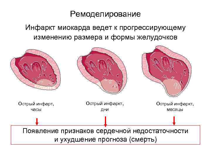 Ремоделирование Инфаркт миокарда ведет к прогрессирующему изменению размера и формы желудочков Острый инфарт, часы