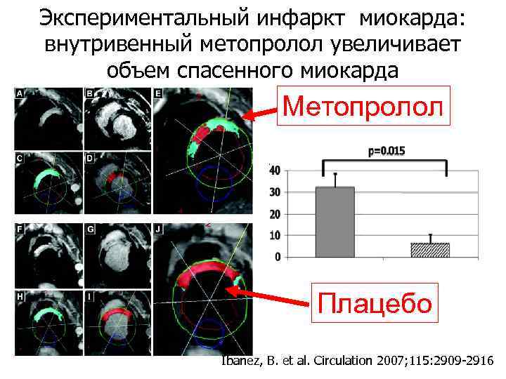 Экспериментальный инфаркт миокарда: внутривенный метопролол увеличивает объем спасенного миокарда Метопролол Плацебо Ibanez, B. et