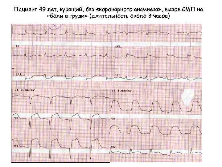 Пациент 49 лет, курящий, без «коронарного анамнеза» , вызов СМП на «боли в груди»