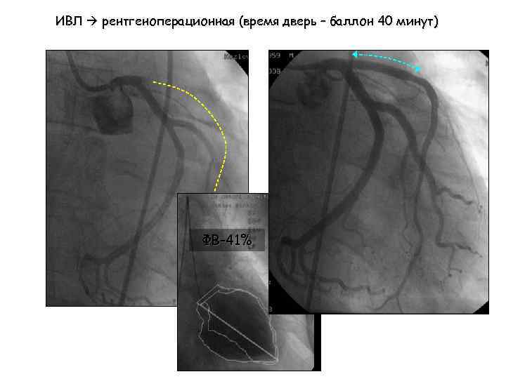 ИВЛ рентгеноперационная (время дверь – баллон 40 минут) ФВ-41% 