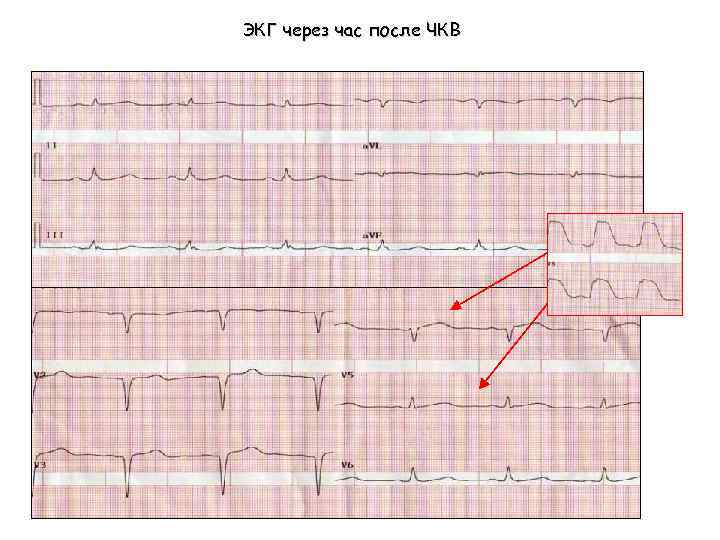 ЭКГ через час после ЧКВ 