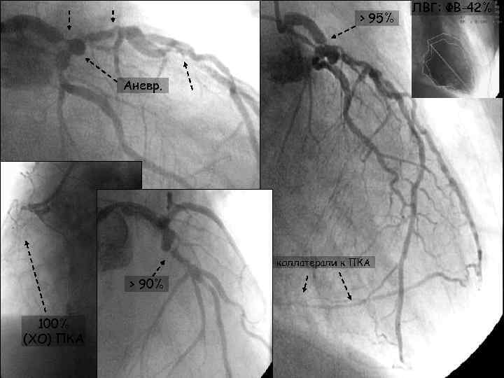 > 95% Аневр. коллатерали к ПКА > 90% 100% (ХО) ПКА ЛВГ: ФВ-42% 