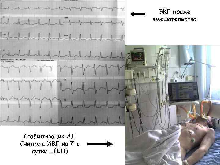 ЭКГ после вмешательства Стабилизация АД Снятие с ИВЛ на 7 -е сутки… (ДН) 