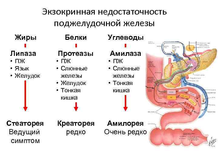 Экзокринная недостаточность поджелудочной железы Жиры Белки Углеводы Липаза Протеазы Амилаза • ПЖ • Язык