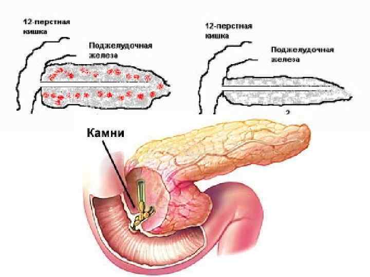 Хр панкреатит