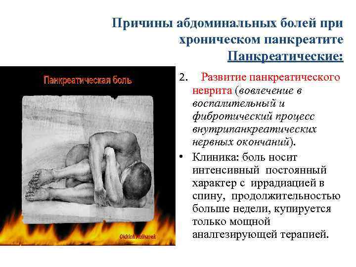 Причины абдоминальных болей при хроническом панкреатите Панкреатические: 2. Развитие панкреатического неврита (вовлечение в воспалительный