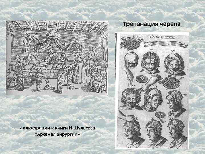 Трепанация черепа Иллюстрации к книги И. Шультеса «Арсенал хирургии» 