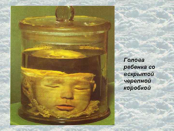 Голова ребенка со вскрытой черепной коробкой 