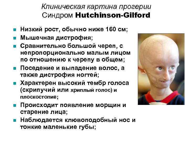  Клиническая картина прогерии Синдром Hutchinson-Gilford n Низкий рост, обычно ниже 160 см; n