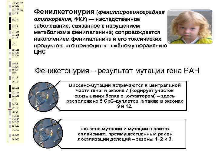 Фенилкетонурия (фенилпировиноградная олигофрения, ФКУ) — наследственное заболевание, связанное с нарушением метаболизма фенилаланина; сопровождается накоплением