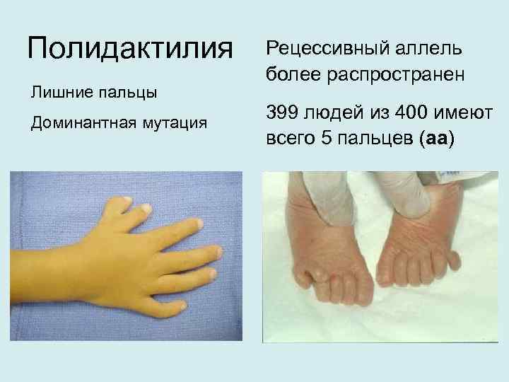 Полидактилия Лишние пальцы Доминантная мутация Рецессивный аллель более распространен 399 людей из 400 имеют