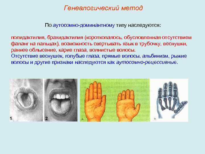 Генеалогический метод По аутосомно-доминантному типу наследуются: полидактилия, брахидактилия (короткопалось, обусловленная отсутствием фаланг на пальцах),