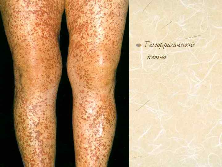 Геморрагические пятна 