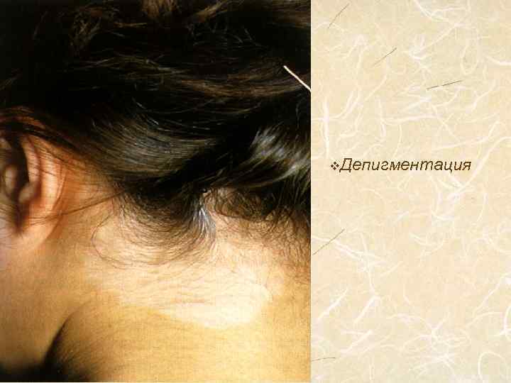 v. Депигментация 