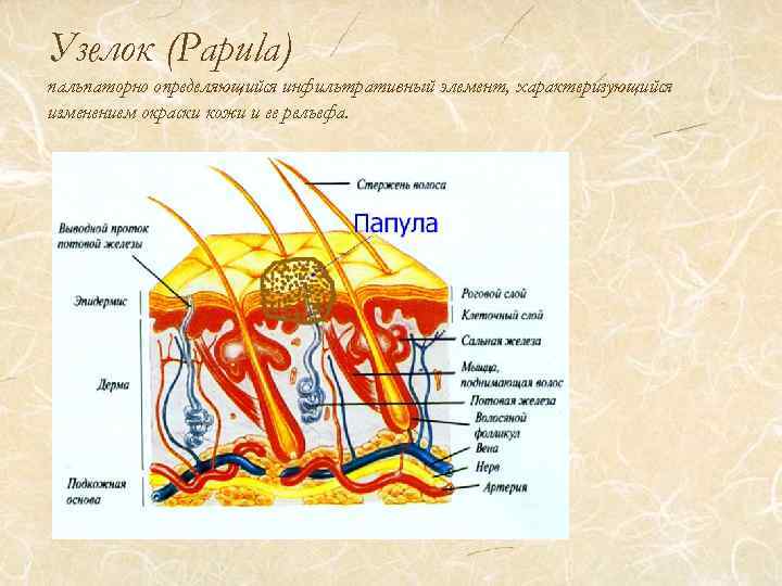 Узелок (Papula) пальпаторно определяющийся инфильтративный элемент, характеризующийся изменением окраски кожи и ее рельефа. 