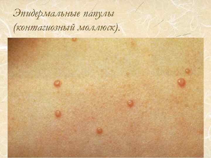 Эпидермальные папулы (контагиозный моллюск). 