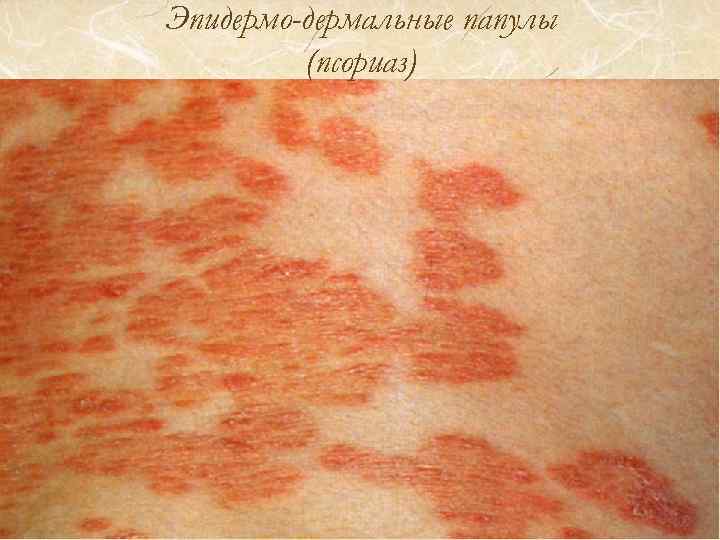 Эпидермо-дермальные папулы (псориаз) 