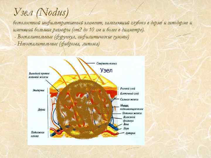 Узел (Nodus) бесполостной инфильтративный элемент, залегающий глубоко в дерме и гиподерме и имеющий большие