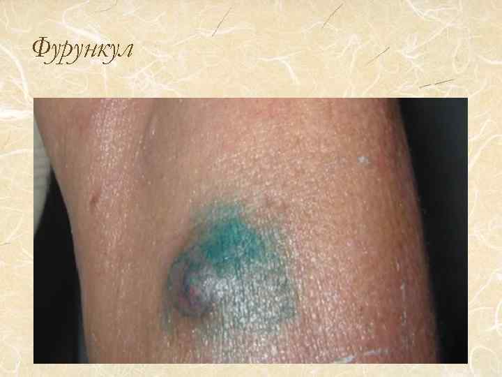 Фурункул 