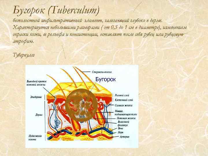 Бугорок (Tuberculum) бесполостной инфильтративный элемент, залегающий глубоко в дерме. Характеризуется небольшими размерами ( от