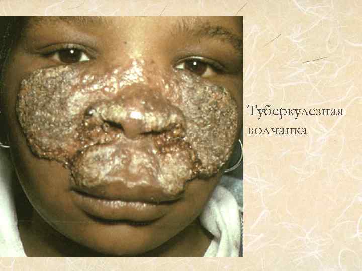 Туберкулезная волчанка 