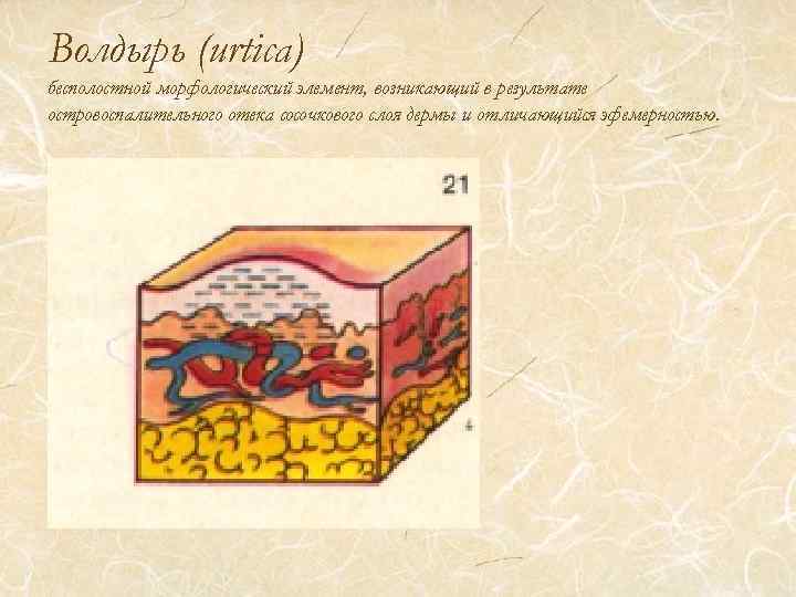 Волдырь (urtica) бесполостной морфологический элемент, возникающий в результате островоспалительного отека сосочкового слоя дермы и