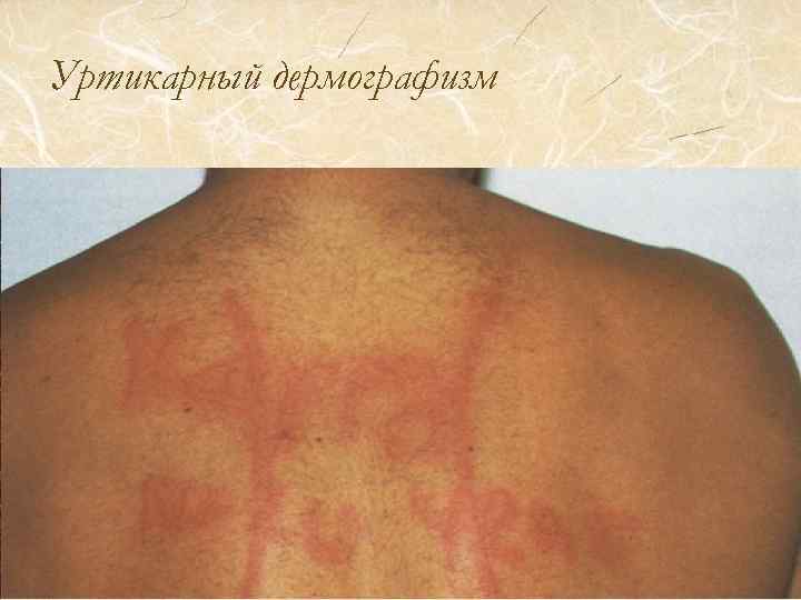 Уртикарный дермографизм 