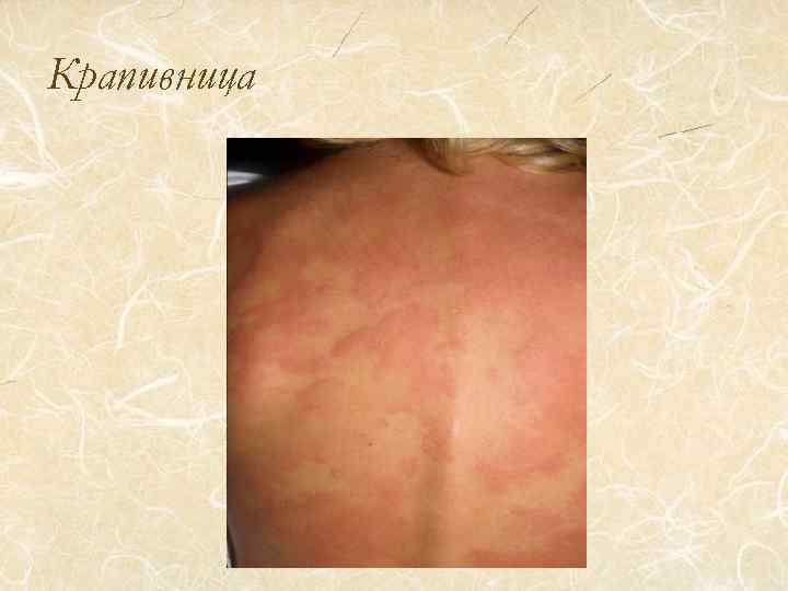 Крапивница 