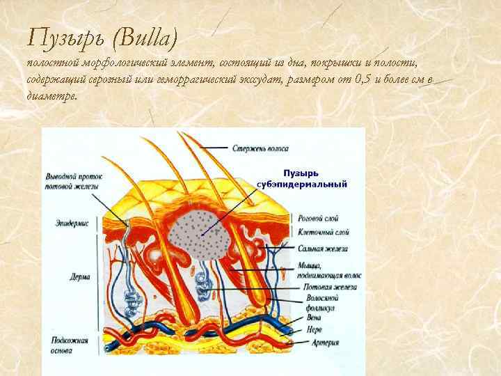 Пузырь (Bulla) полостной морфологический элемент, состоящий из дна, покрышки и полости, содержащий серозный или