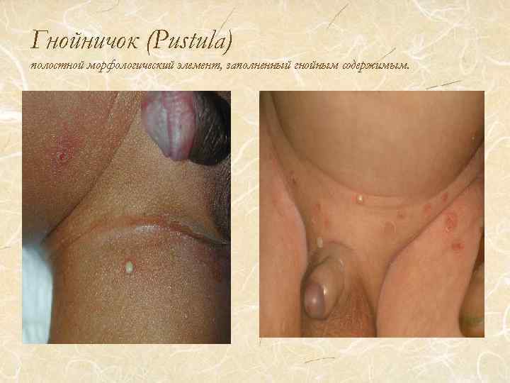 Гнойничок (Pustula) полостной морфологический элемент, заполненный гнойным содержимым. 