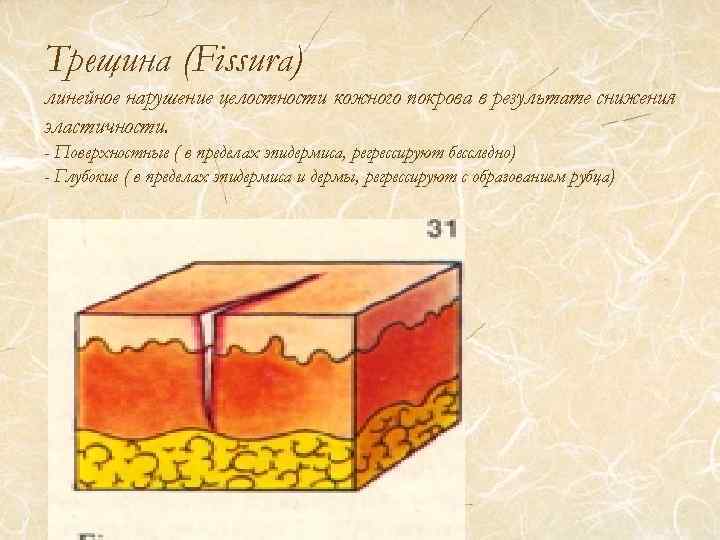 Трещина (Fissura) линейное нарушение целостности кожного покрова в результате снижения эластичности. - Поверхностные (