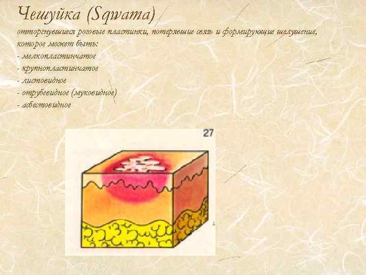 Чешуйка (Sqwama) отторгнувшиеся роговые пластинки, потерявшие связь и формирующие шелушение, которое может быть: -