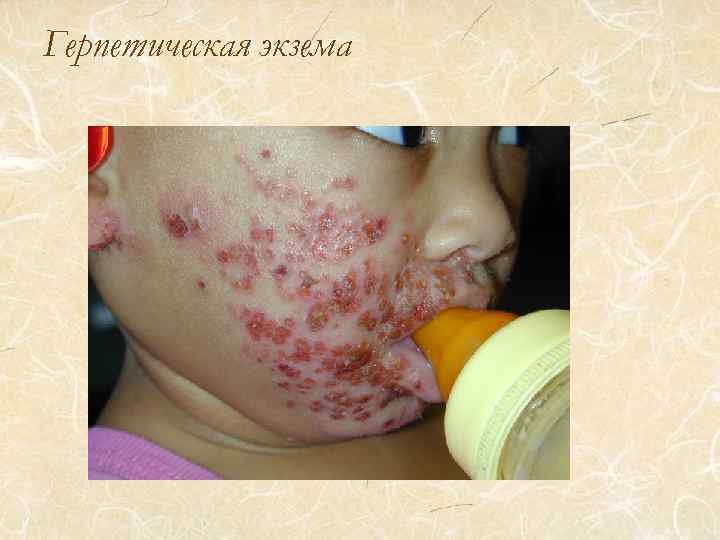 Герпетическая экзема 