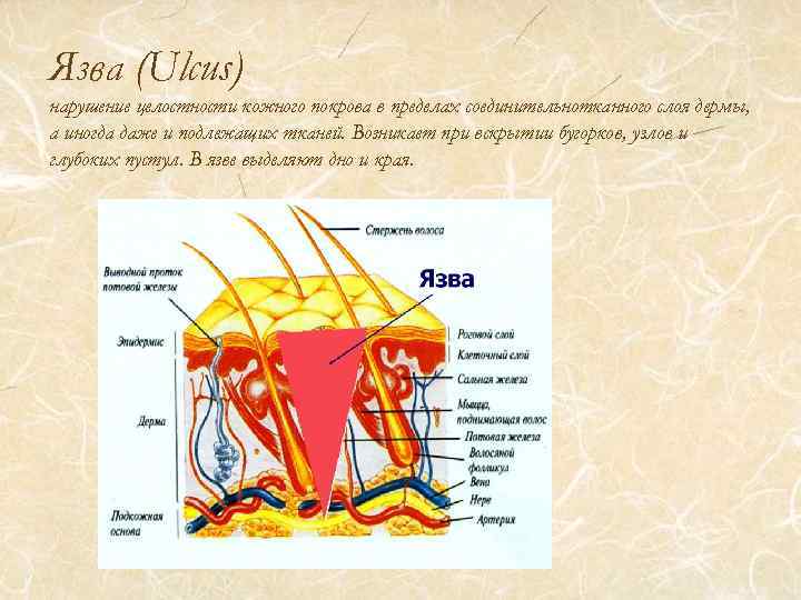 Язва (Ulcus) нарушение целостности кожного покрова в пределах соединительнотканного слоя дермы, а иногда даже