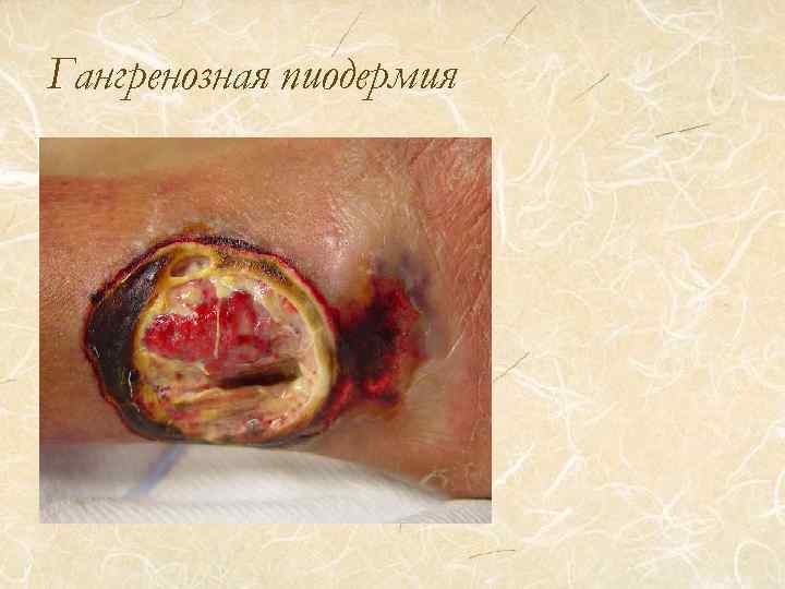 Гангренозная пиодермия 