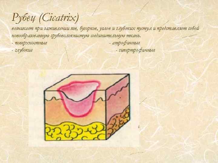 Рубец (Cicatrix) возникает при заживлении язв, бугорков, узлов и глубоких пустул и представляет собой