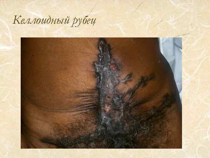 Келлоидный рубец 