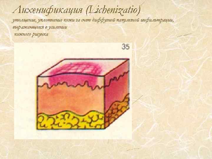 Лихенификация (Lichenizatio) утолщение, уплотнение кожи за счет диффузной папулезной инфильтрации, выражающееся в усилении кожного