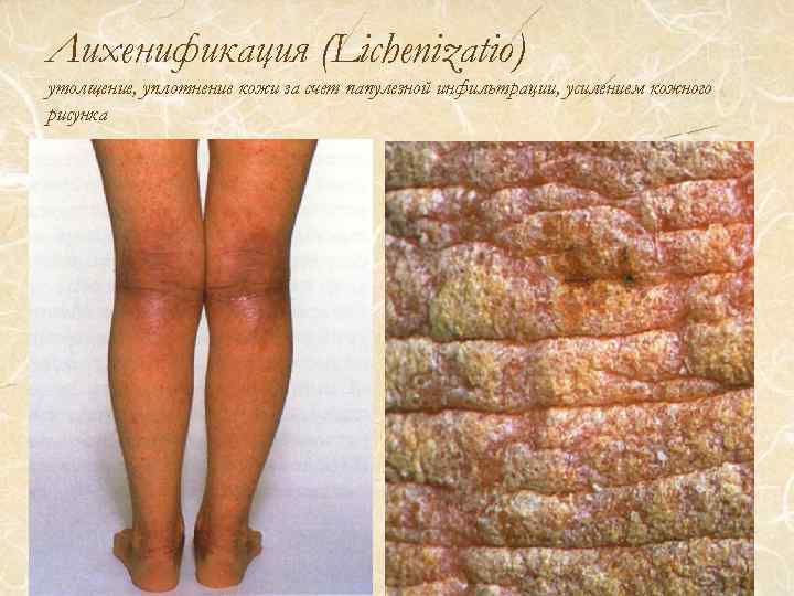 Лихенификация (Lichenizatio) утолщение, уплотнение кожи за счет папулезной инфильтрации, усилением кожного рисунка 