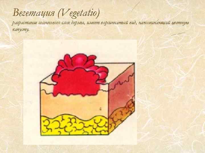 Вегетация (Vegetatio) разрастание сосочкового слоя дермы, имеет ворсинчатый вид, напоминающий цветную капусту. 