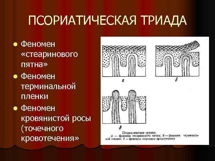 ПСОРИАТИЧЕСКАЯ ТРИАДА Феномен «стеаринового пятна» l Феномен терминальной пленки l Феномен кровянистой росы (точечного