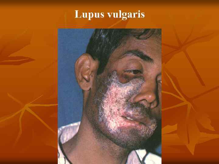 Lupus vulgaris 