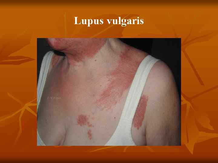 Lupus vulgaris 