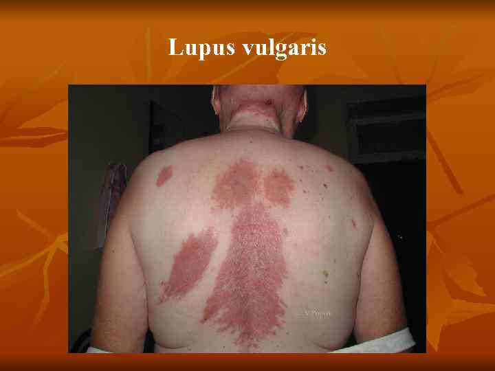 Lupus vulgaris 