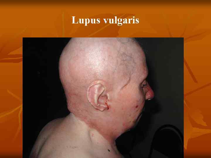 Lupus vulgaris 